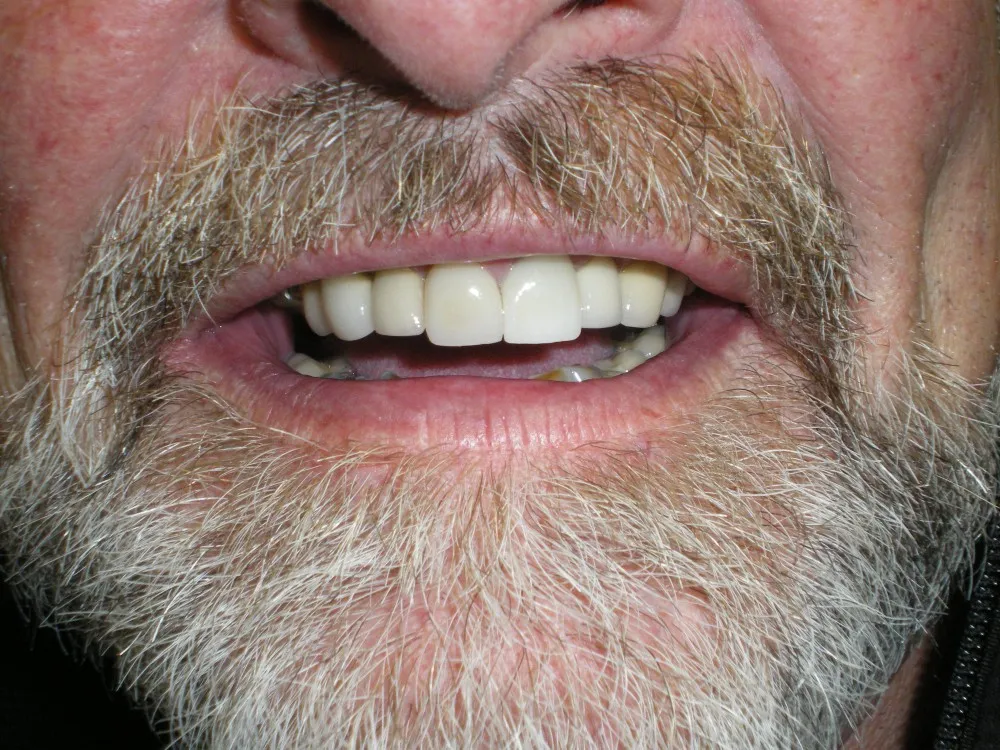 After Dental Implants