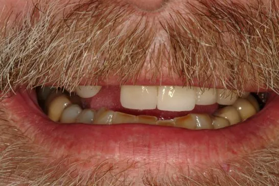 Before Dental Implants, patient missing tooth