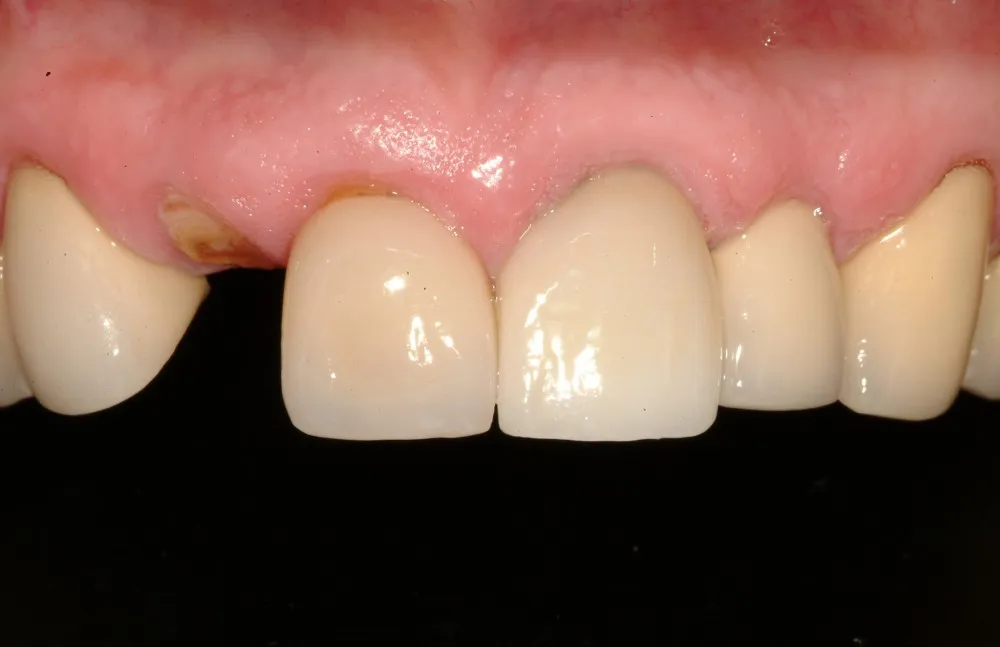 Before Dental Implants