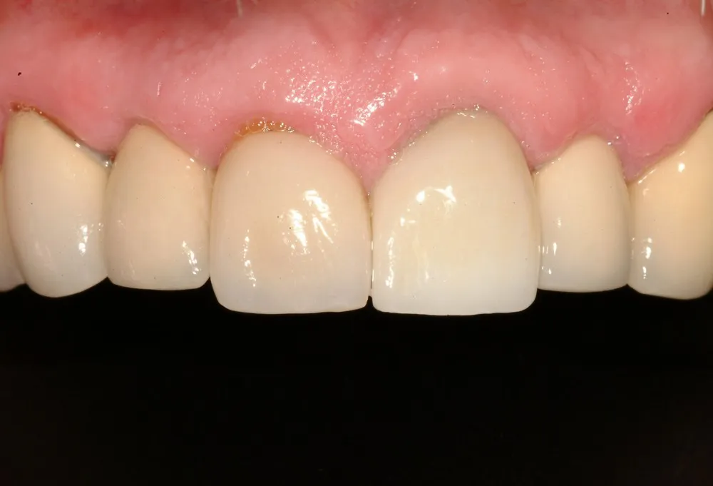 After Dental Implants
