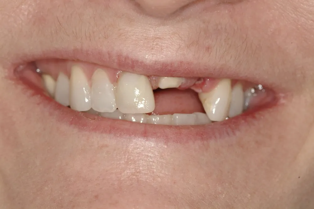 Miising Front Tooth, Before Dental Implants