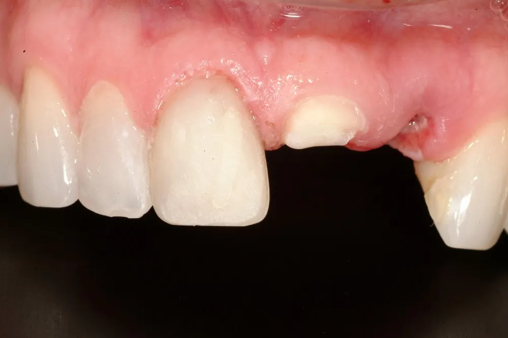 Missing Front Tooth, Before Dental Implants
