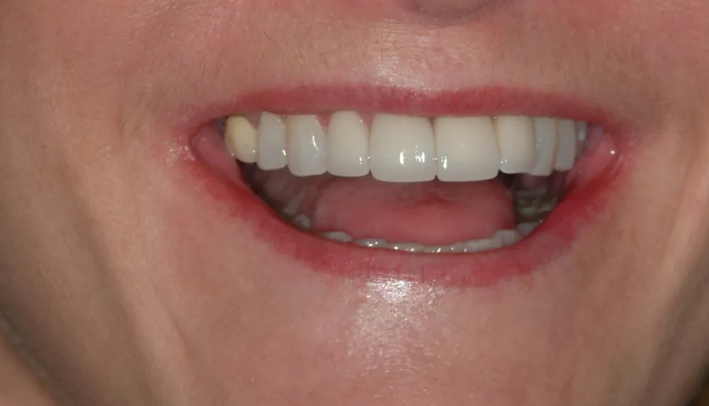 After Dental Implants