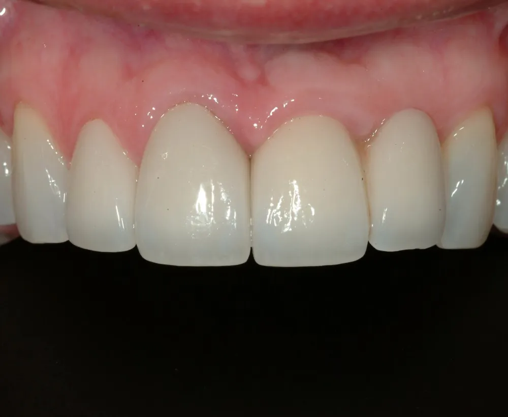 After Dental Implants