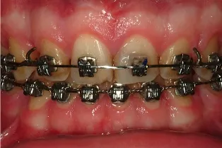 After Gingivectomy Treatment case study photo