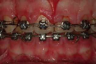 Before Gingivectomy case study, with braces