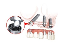 All-on-4 illustration and magnification of some detail
