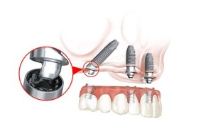 All-on-4 illustration and magnification of some detail