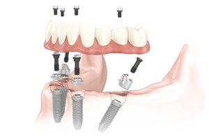 All-on-4® treatment concept