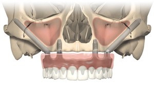 All-on-4 addes a full set of teeth on 4 dental implants