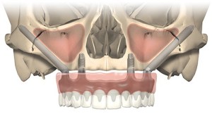 All-on-4 addes a full set of teeth on 4 dental implants