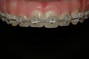 Frenectomy - After Treatment