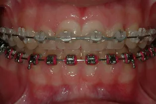 After Gingivectomy Treatment case study photo, patient wearing braces