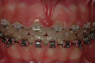 Before Gingivectomy Case Study, patient wearing braces