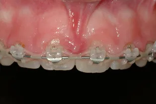 Before Frenectomy